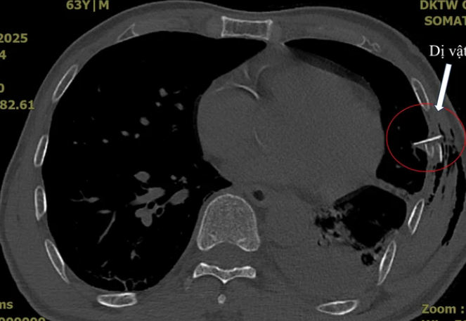 Tưởng chỉ xây xước nhẹ, bệnh nhân suýt mất mạng vì gãy xương sườn